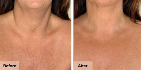 dermaroller neck before and after.